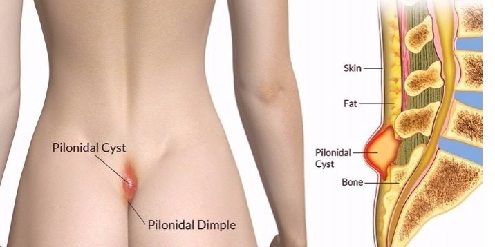 Tük dönməsi (Pilonidal sinus) nədir