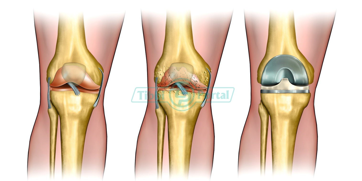 Artroplastika