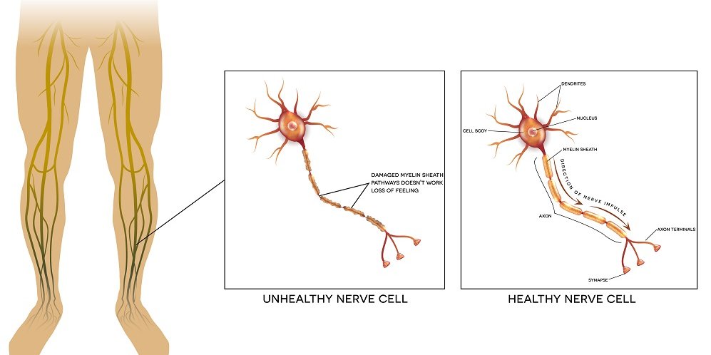 Neyropatiya nədir və səbəbləri