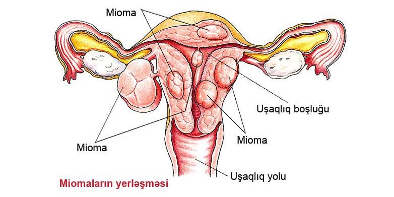 Uşaqlığın mioması