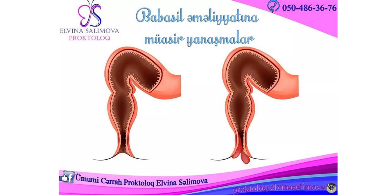 Babasil əməliyyatı