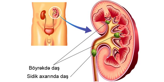 Böyrək daşı