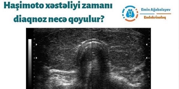 Haşimoto xəstəliyi zamanı diaqnoz necə qoyulur, hashimoto xesteliyi zamani diaqnoz nece qoyulur