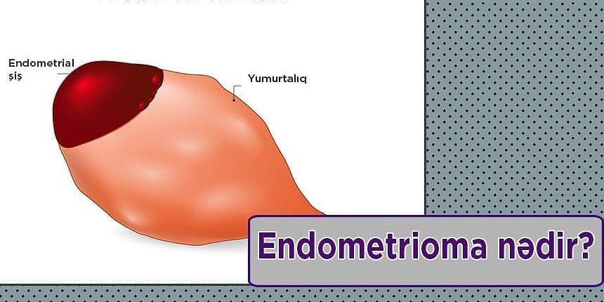 Endometrioma