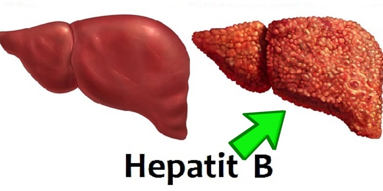 HEPATIT B virusu nədir?