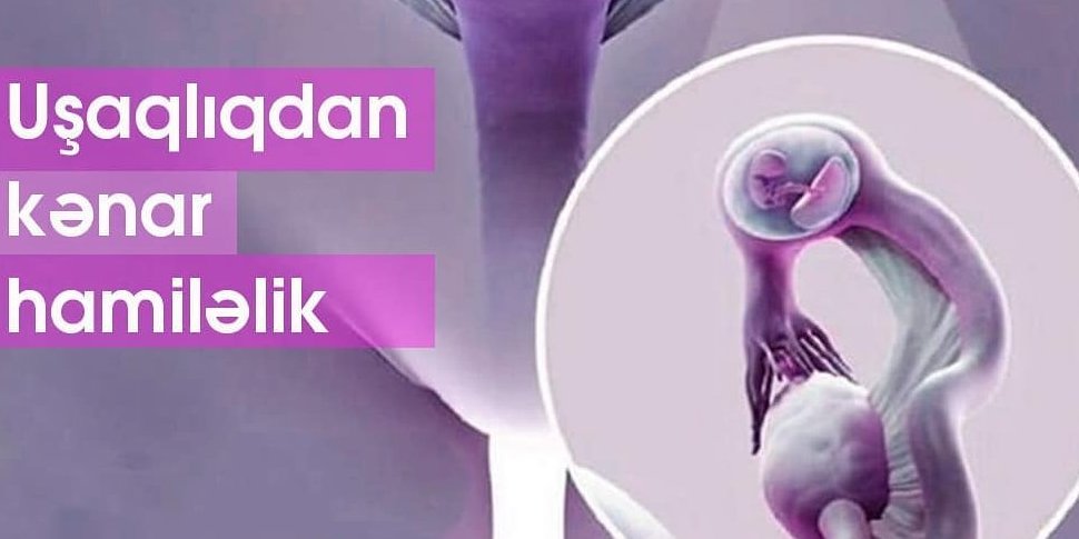 Uşaqlıqdankənar hamiləliyin müalicəsi əməliyyatsız mümkündür, ushaqliqdankenar hamileliyin mualicesi emeliyyatsiz mumkundurmu