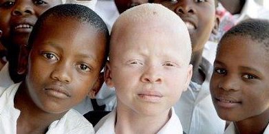 Albinizm