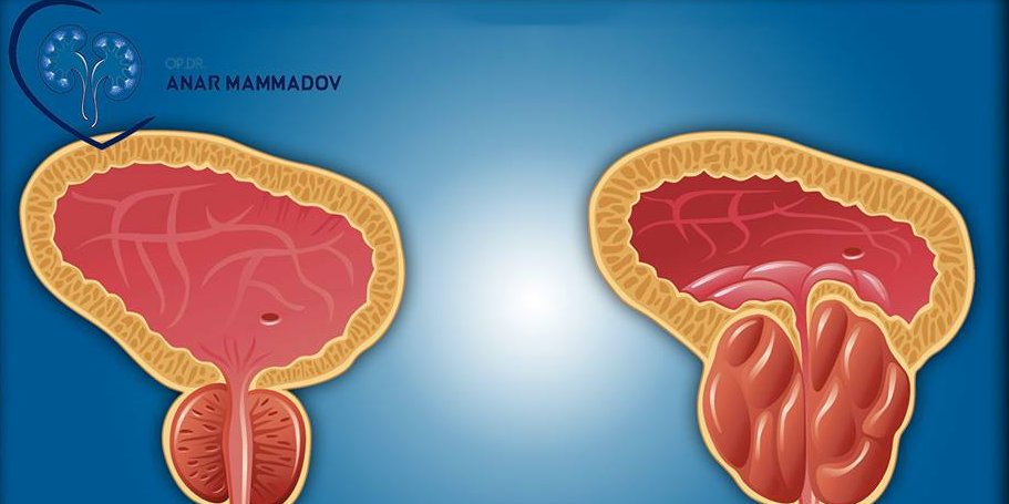 Prostat vəzi haqda doğru bildiyimiz yanlışlar