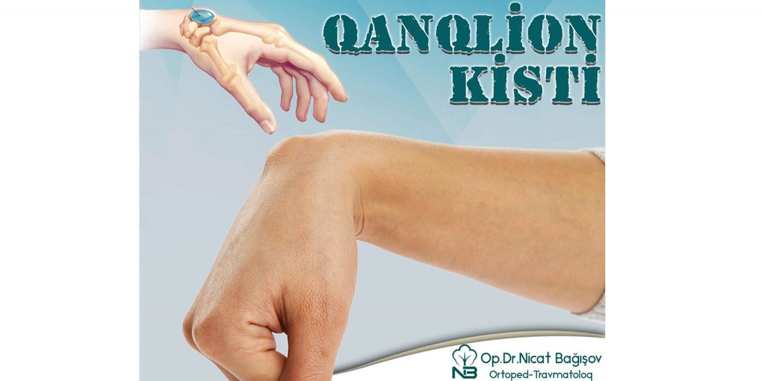 Qanqlion kisti