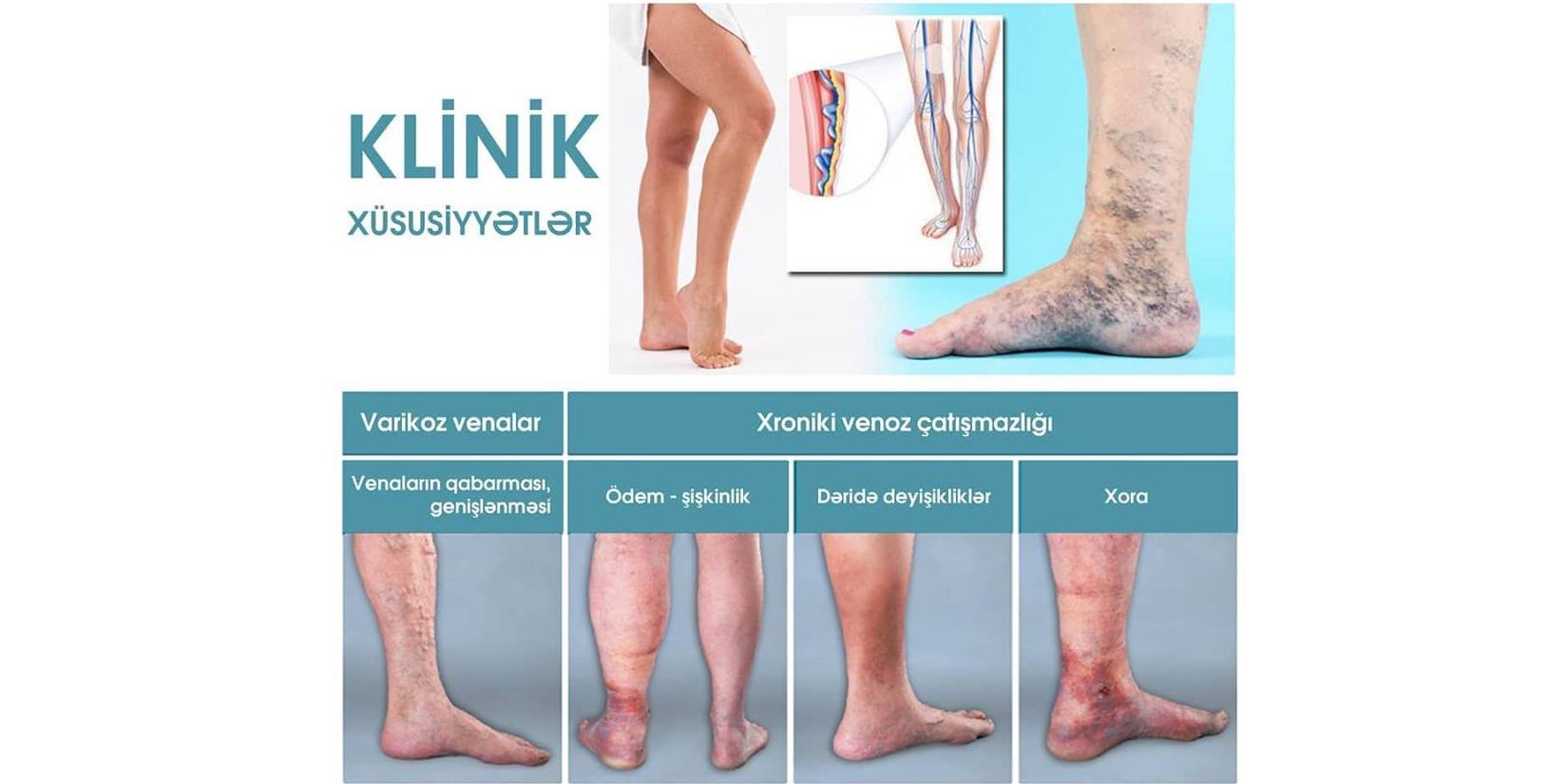 Xronik venoz pozğunluqları