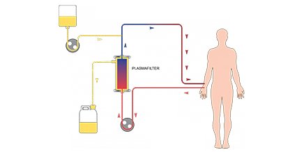 Plazmaferezdən hansı xəstəliklərdə istifadə olunur?