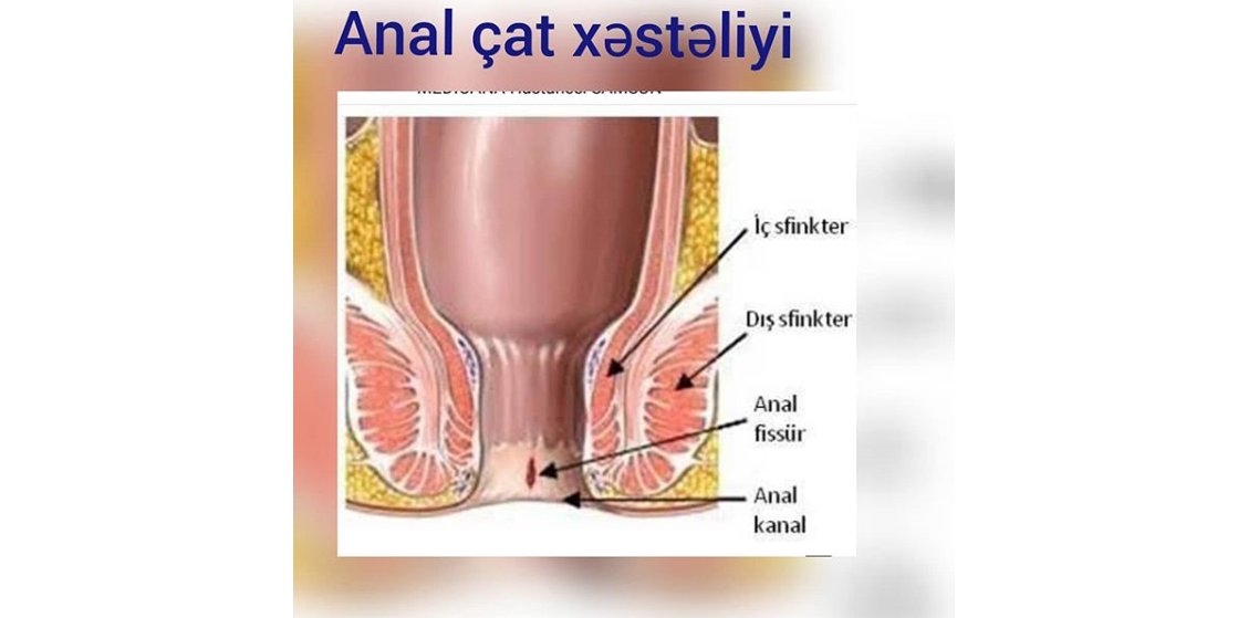 Anal fissur