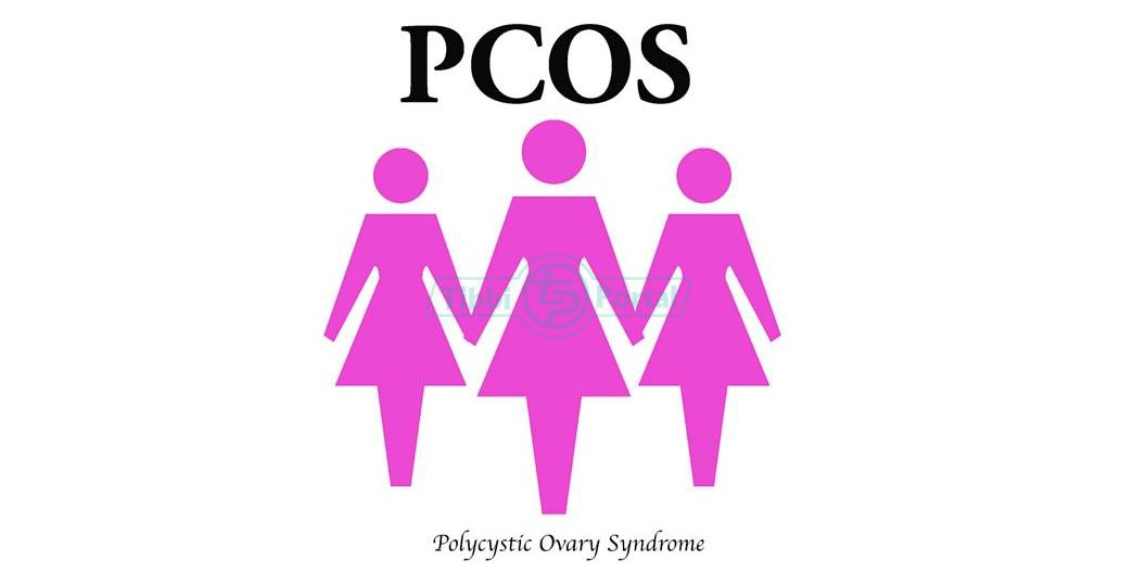 Qadınlarda Polikistik Yumurtalıq Sindromu (PCOS)