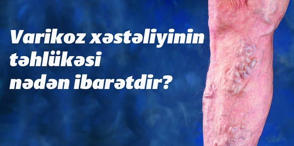 Varikoz xəstəliyinin təhlükəsi nədən ibarətdir?