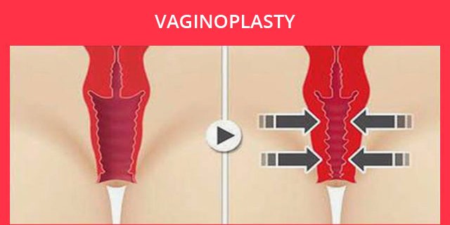 Vaginoplastika- intim plastika