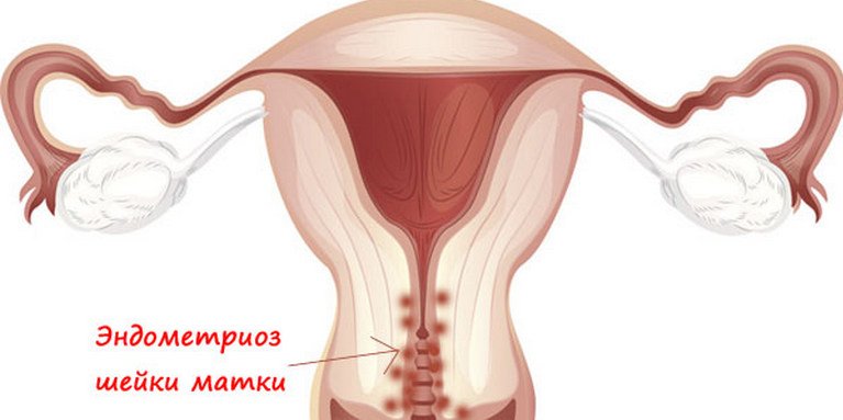 Эндометриоз шейки матки