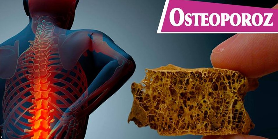 Osteoporoz