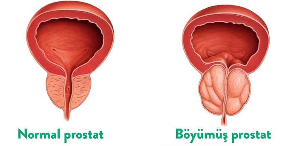 Prostat vəzinin adenoması