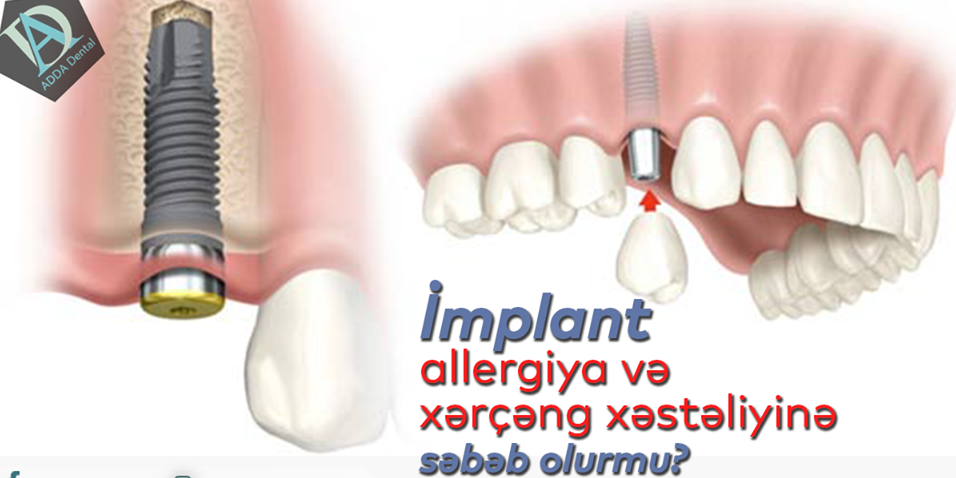 İmplant allergiya və xərçəng xəstəliyinə səbəb olurmu?