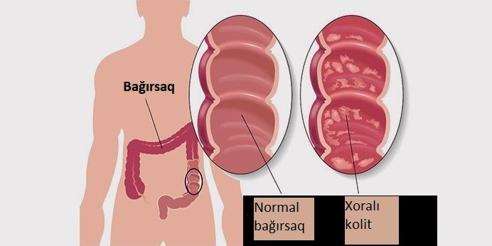 Xroniki xoralı kolit