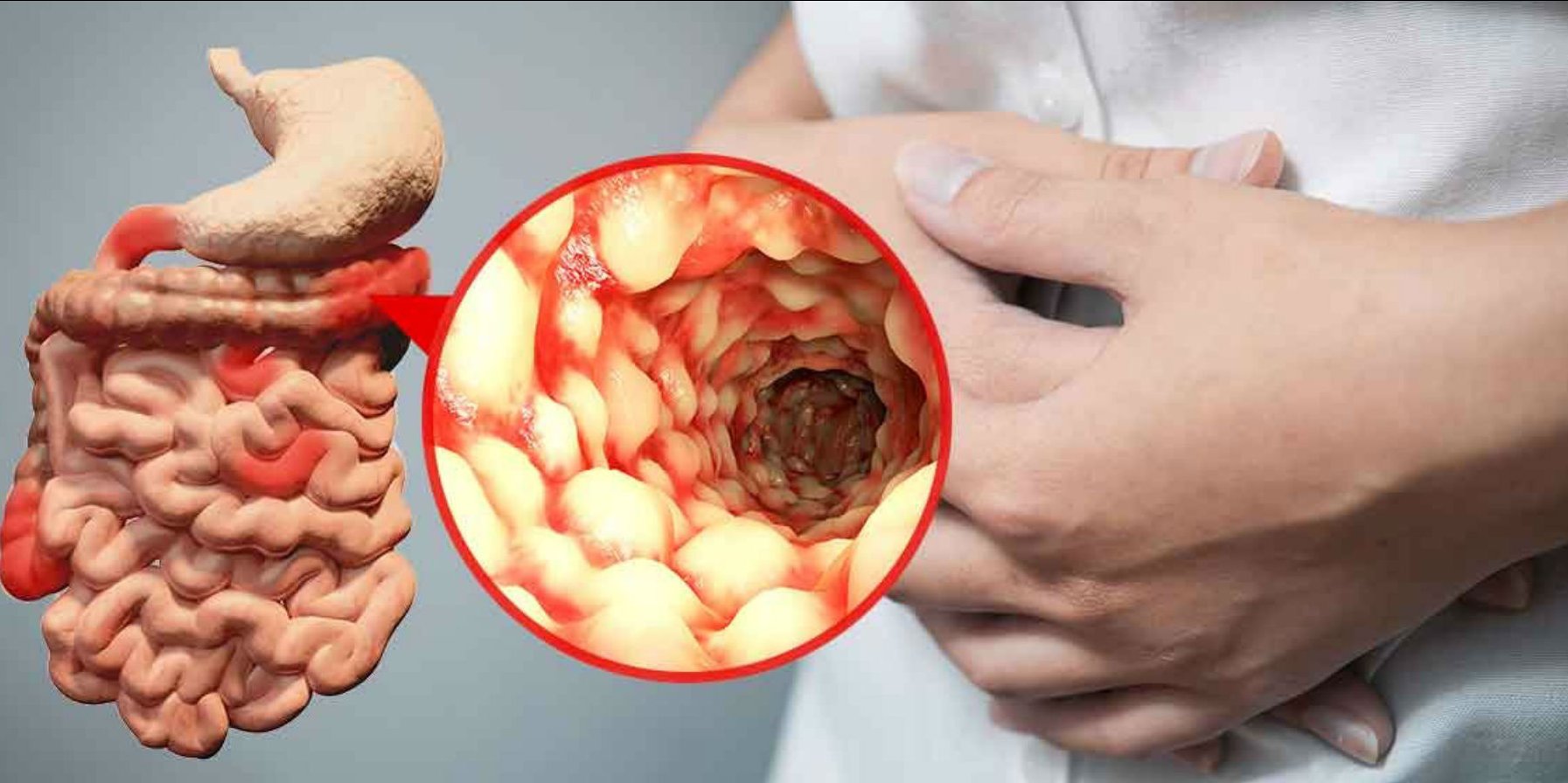 Crohn xəstəliyinin və ulserativ (xoralı) kolitin bioloji müalicəsi.