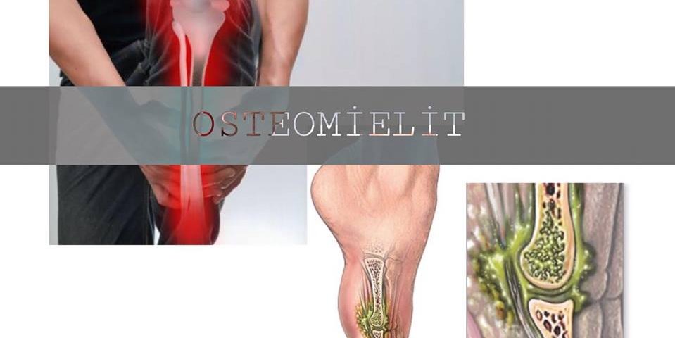 Osteomielit