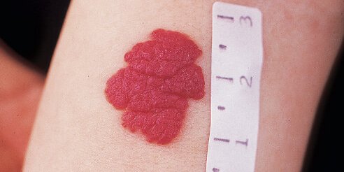 Hemangioma nədir?