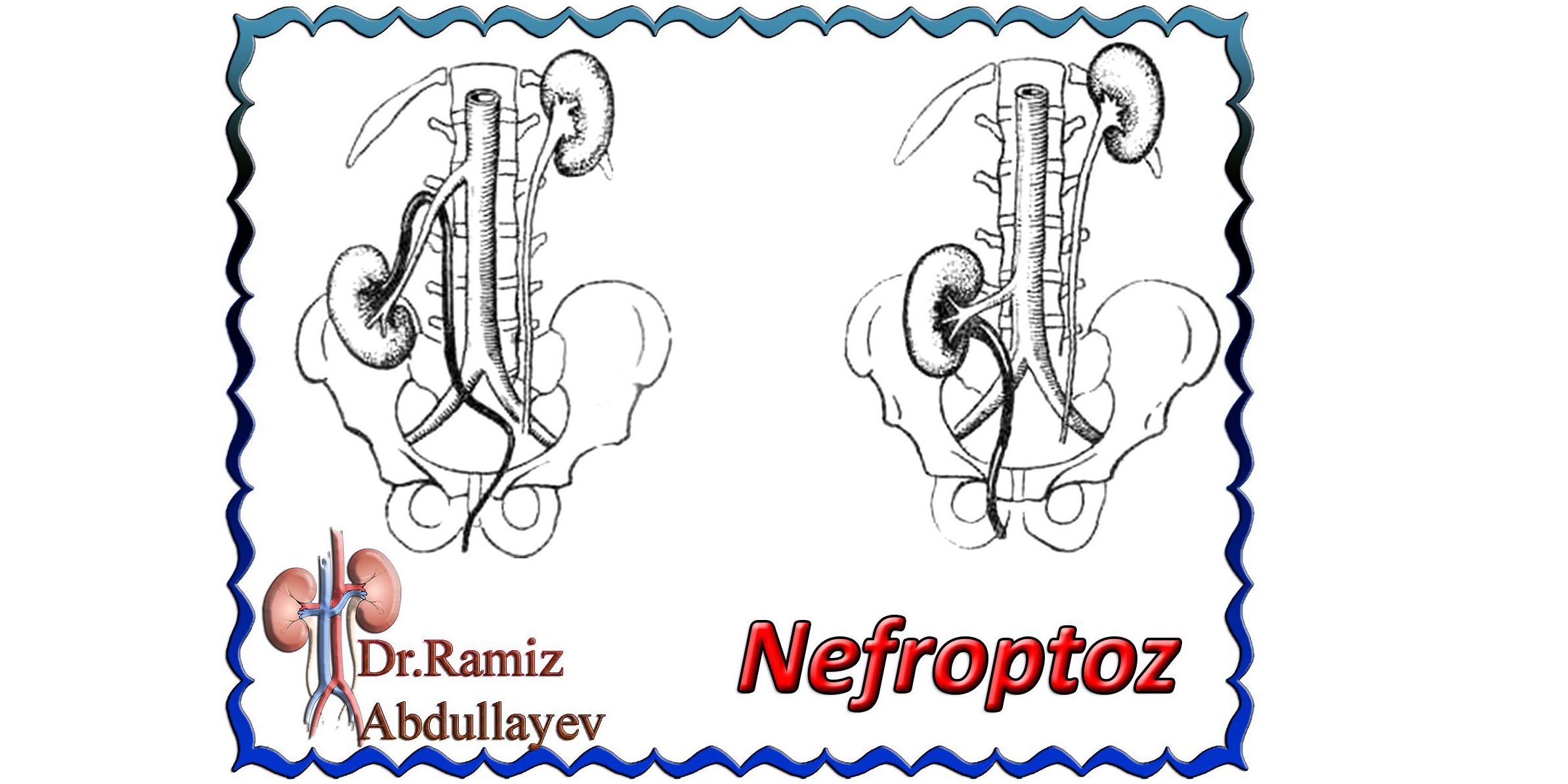 Nefroptoz