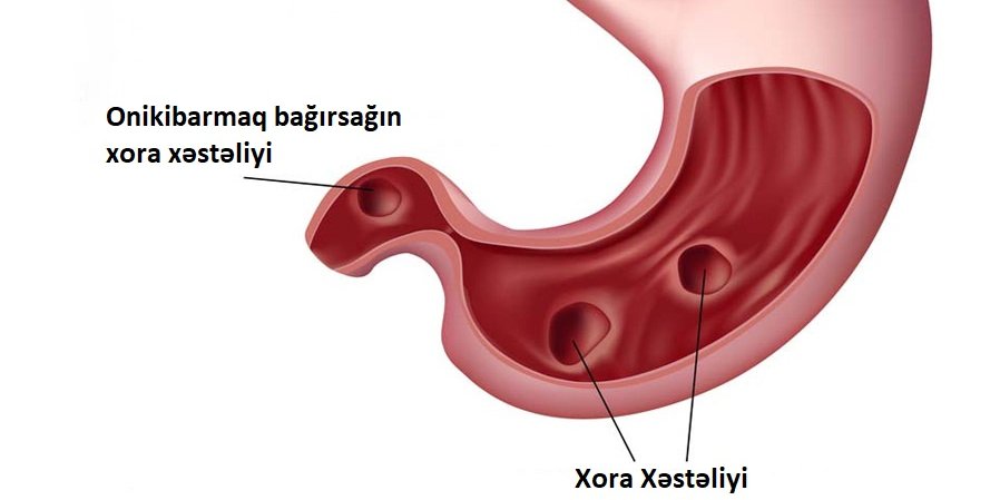 Mədə və onikibarmaq bağırsağın xora xəstəliyi